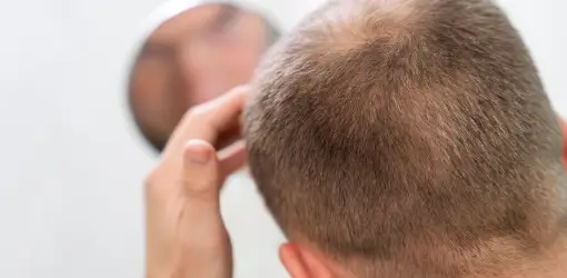 Causas de la alopecia areata